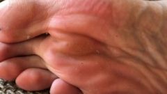 Dry Nasty Hard Feet And Soles Closeup