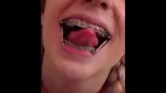 Aspen Metal Mouth Closeup
